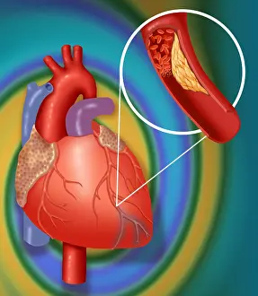 Clots Prints: Heart Attack Showing Blood Clot