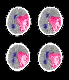 Computed Prints: Hemorrhagic Stroke