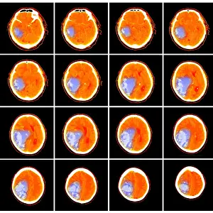 Scan Prints: Hemorrhagic Stroke