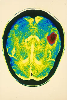 Computed Prints: Hemorrhagic stroke, CT Scan