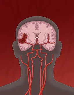 Bleeding Prints: Hemorrhagic Stroke, Illustration