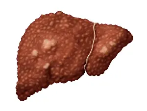 Malignancies Prints: Hepatocellular Carcinoma