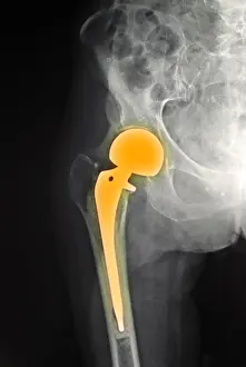 Density Prints: Hip Fracture with Prosthesis