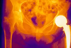 Density Prints: Hip Replacement and Osteoporosis, X-ray