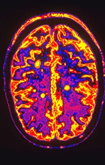 Magnetic Prints: Human Brain with MS