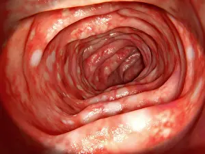 Abnormal Prints: Human colon affected by ulcerative colitis