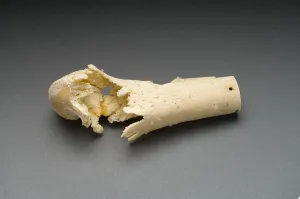 Details Prints: Human Distal Femur, Gunshot Wound, 1984