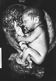 Cord Prints: Human fetus