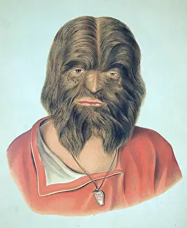 Anomaly Prints: Hypertrichosis, 19th Century