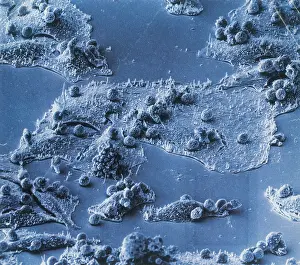 Leukocytes Prints: Immune Cells Attacking Cancer Cells, under a microscope (SEM)