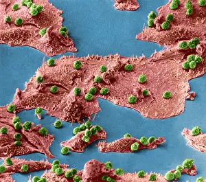 Immune Cells Attacking Cancer Cells, under a microscope (SEM)