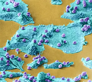 Disorders Prints: Immune Cells Attacking Cancer Cells, under a microscope (SEM)