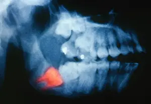 Wisdom Prints: Impacted Wisdom Tooth, X-ray