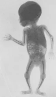 Medical Prints: Infant X-Ray, 1900