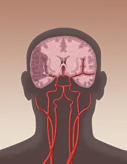 Flows Prints: Ischemic Stroke, Illustration