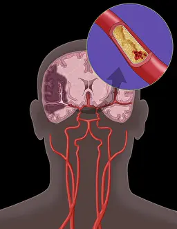 Clots Prints: Ischemic Stroke, Illustration