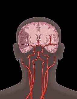 Flow Prints: Ischemic Stroke, Illustration