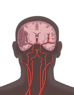 Flow Prints: Ischemic Stroke, Illustration