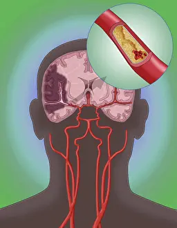 Clots Prints: Ischemic Stroke, Illustration