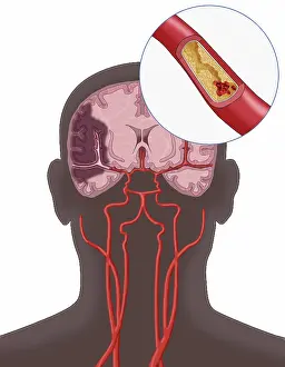 Clots Prints: Ischemic Stroke, Illustration