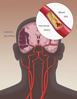 Clots Prints: Ischemic Stroke, Illustration