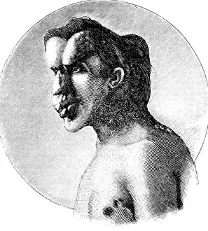 Malformation Prints: Joseph Merrick, The Elephant Man