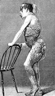 Malformation Prints: Joseph Merrick, The Elephant Man