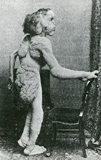 John Prints: Joseph Merrick, The Elephant Man