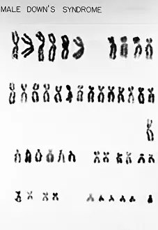 Segment Prints: Karyotype, Down Syndrome