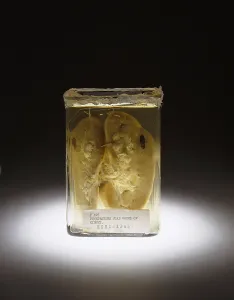 Court Prints: Kidney, Stab Wound, 1937