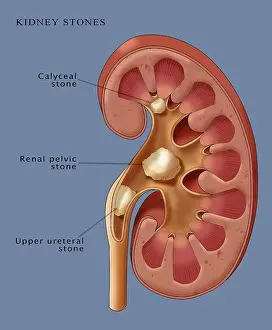 Stone Prints: Kidney Stones, Illustration