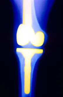 Radiographs Prints: Knee replacement x-ray of a 38 year old female