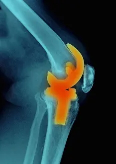 Knee Prints: Knee Replacement, X-ray