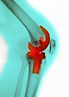 Knee Prints: Knee Replacement, X-ray