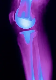 System Prints: Knee Replacement X-ray
