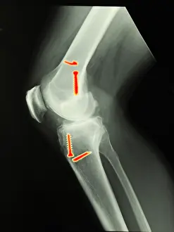 Diagnosis Prints: Knee Surgery
