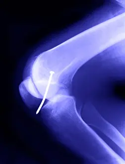 Radiographs Prints: Knee X-Ray