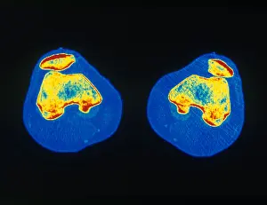 Project Prints: Knees, CT Scan
