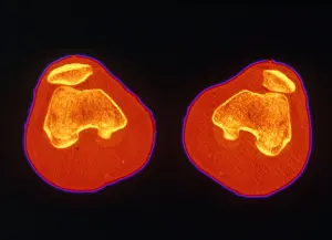 Project Prints: Knees, CT Scan