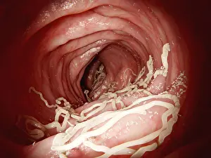Many Science & Medical Prints: Large roundworm in human intestines