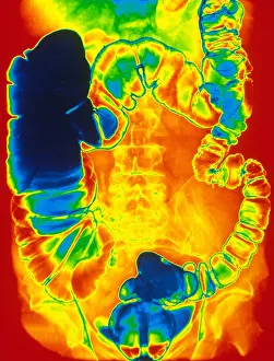 Small Prints: Large and Small Intestine, Barium X-ray