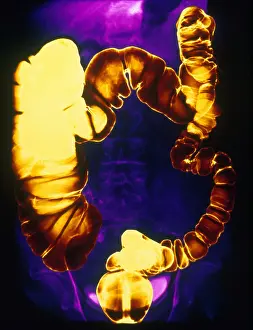 Test Prints: Large and Small Intestine, Barium X-ray