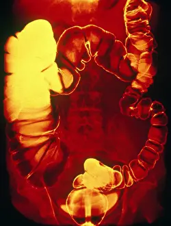 Test Prints: Large and Small Intestine, Barium X-ray