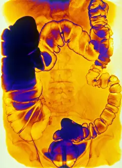 Test Prints: Large and Small Intestine, Barium X-ray