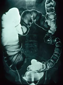 Test Prints: Large and Small Intestine, Barium X-ray