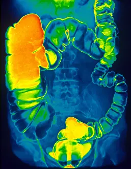 Test Prints: Large and Small Intestine, Barium X-ray