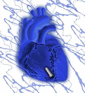 Leadless Pacemaker and Heart