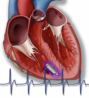 Pacemaker Prints: Leadless Pacemaker, Illustration