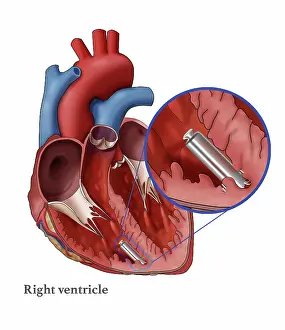 Pacemaker Prints: Leadless Pacemaker, Illustration