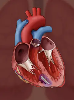 Pacemaker Prints: Leadless Pacemaker, Illustration